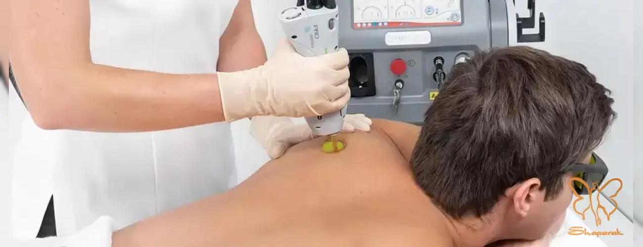 پایان شیو روزانه! لیزر موهای زائد آقایان در کلینیک شاپرک طلایی مشهد 