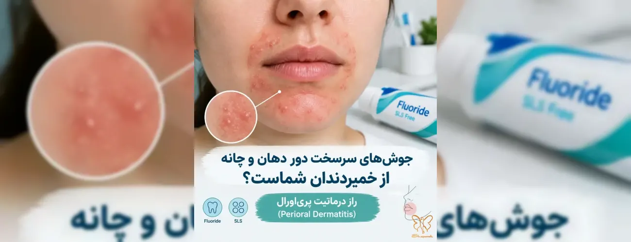 جوش‌های سرسخت دور دهان و چانه از خمیر دندان شماست؟ راز درماتیت پری‌اورال (Perioral Dermatitis)