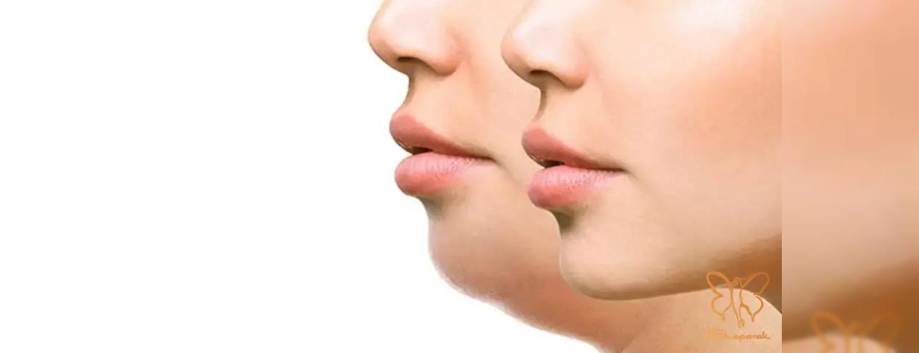 آیا ساکشن غبغب خطرناک است؟ پاسخ قطعی به تمام سوالات و نگرانی‌های شما 