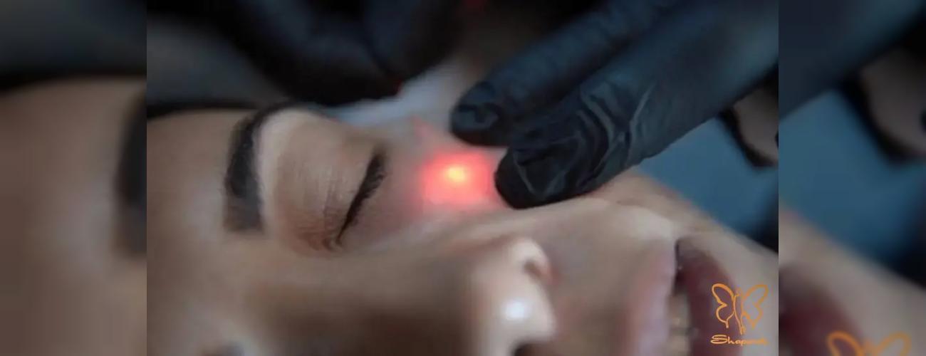 اندولیفت برای اسکار: راه حلی نوین برای درمان اسکار و آکنه در کلینیک شاپرک طلایی