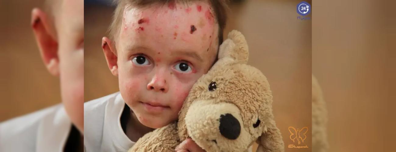 بیماری پروانه ای چیست؟ حقایقی درباره کودکان پروانه‌ای در مشهد