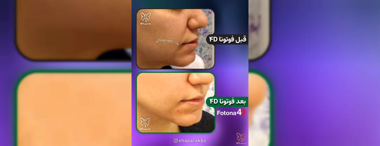 جوانسازی پوست با لیزر فوتونا فوردی: نه یک درمان، بلکه یک تولد دوباره!