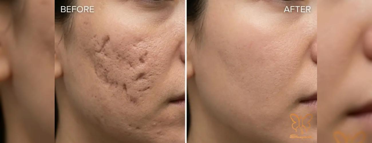 همه چیز درباره کامبینیشن تراپی صورت | هزینه، مزایا و مراحل درمان در شاپرک طلایی مشهد