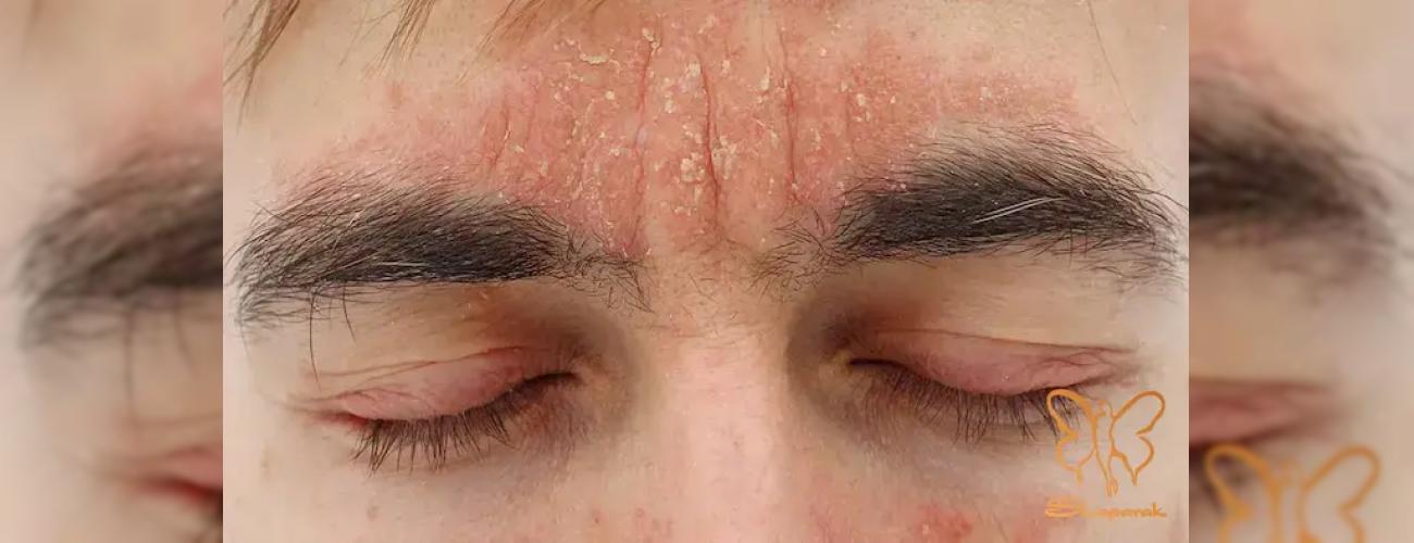 پوسته پوسته شدن صورت نشانه چیست؟ درمان قطعی در بهترین کلینیک پوست مشهد