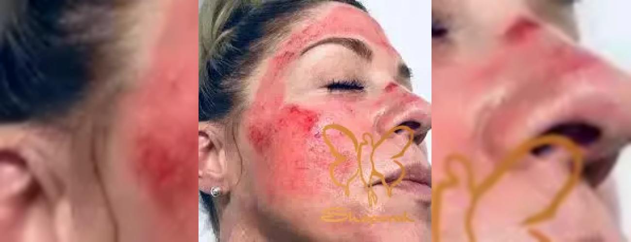 احساس سوختگی بعد از پیلینگ؛ آیا طبیعی است یا خطرناک؟ (راهنمای کامل)