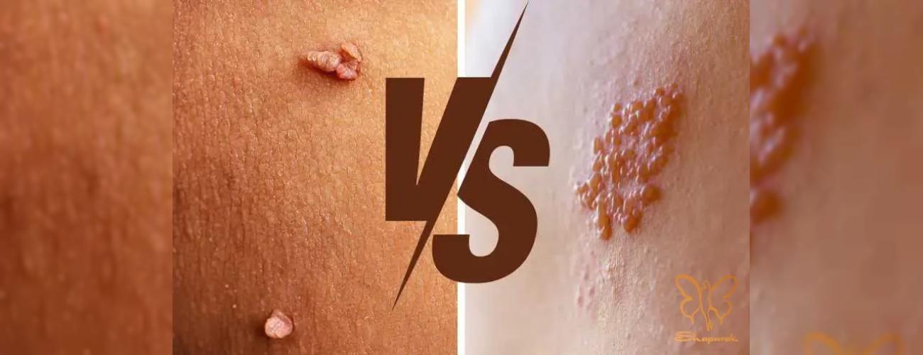 تبخال و زگیل تناسلی (HPV و HSV): آیا انجام خدمات زیبایی مجاز است؟