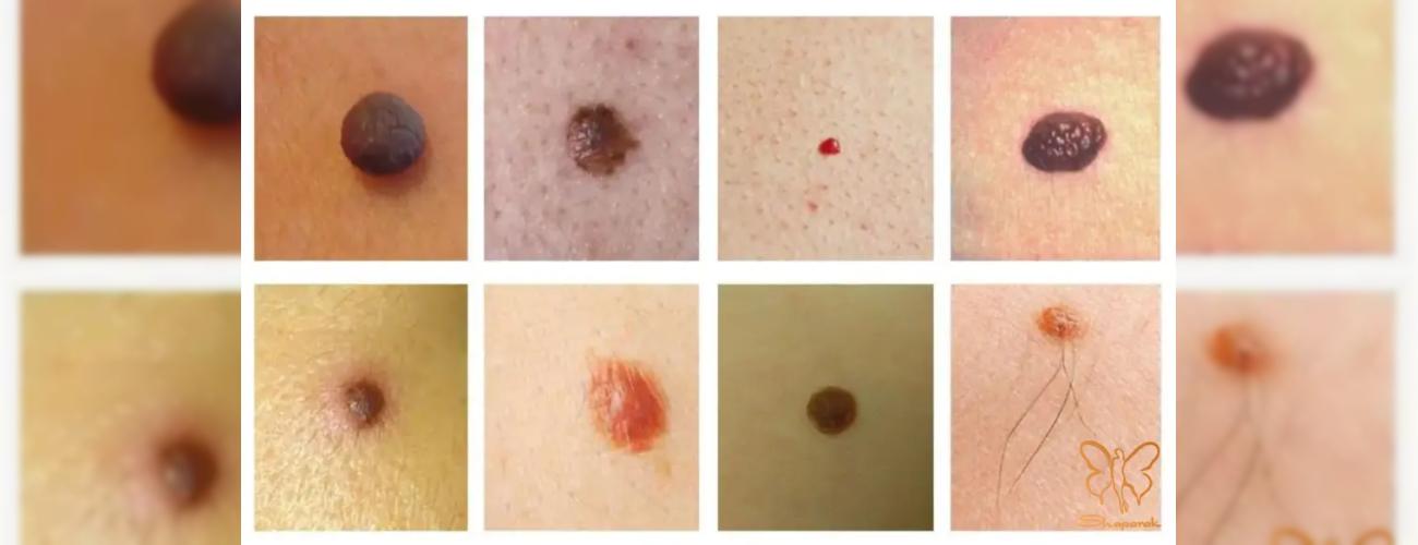 انواع خال های پوستی و شناخت آن ها در مشهد