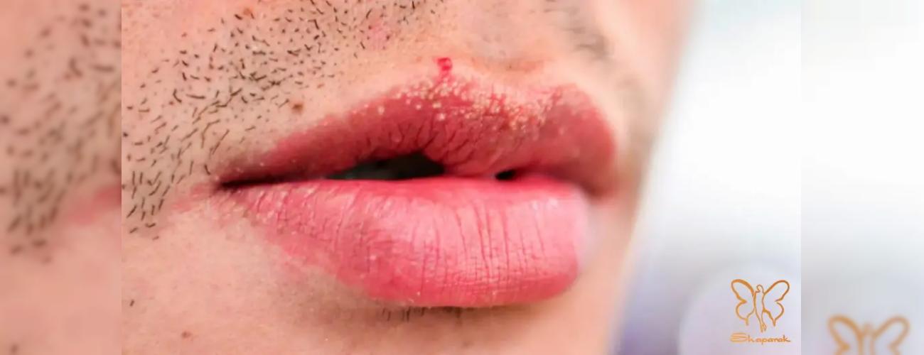 فوردایس لب چیست؟ جامع‌ ترین راهنمای درمان دانه‌ های سفید روی لب در مشهد