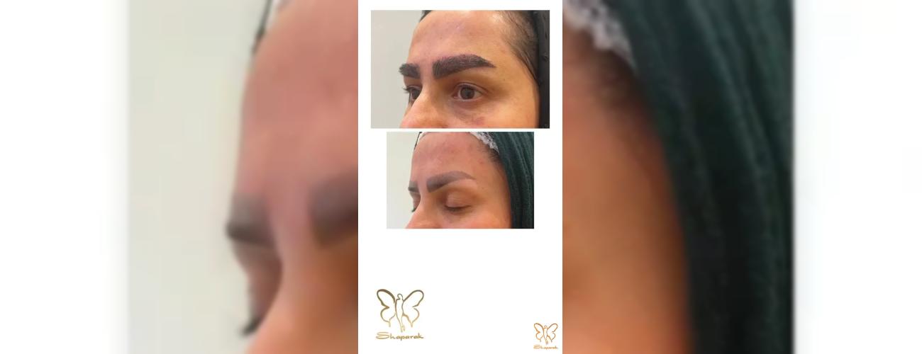 کاشت و پرپشت‌سازی ابروها در کلینیک شاپرک طلایی مشهد