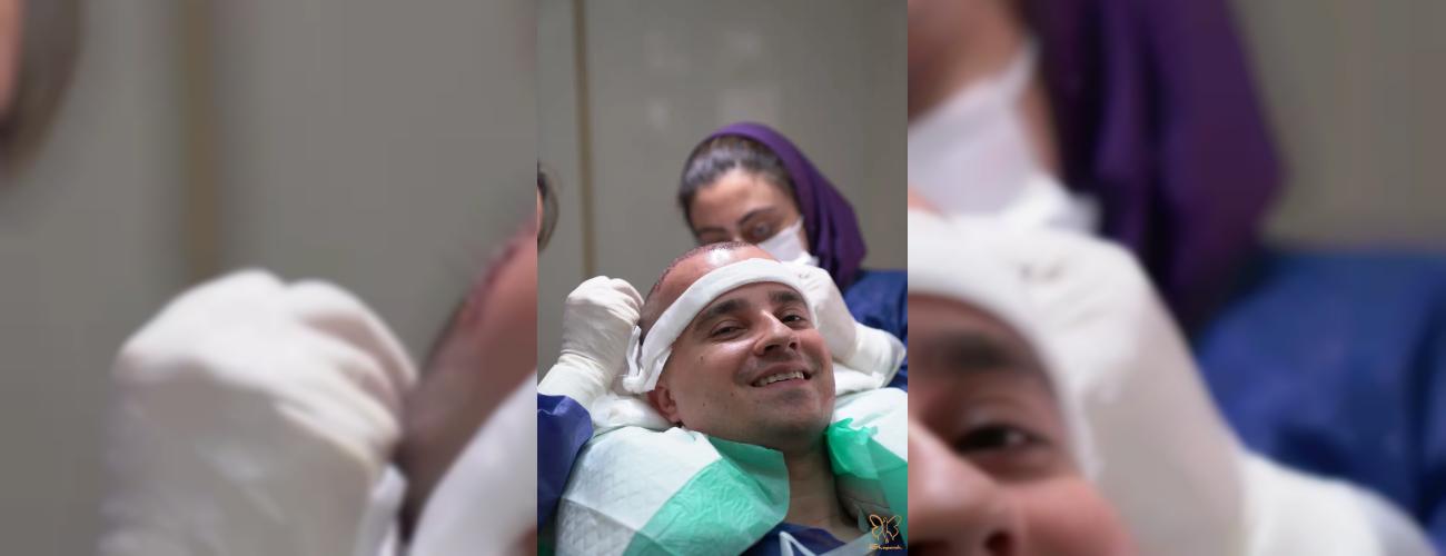 ورم بعد از کاشت مو چقدر طول می‌کشد؟ | راهنمای کامل کلینیک شاپرک طلایی