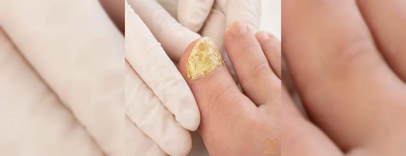 از شر زردی و شکنندگی ناخن پا خلاص شوید! (علائم و درمان قارچ ناخن پا)