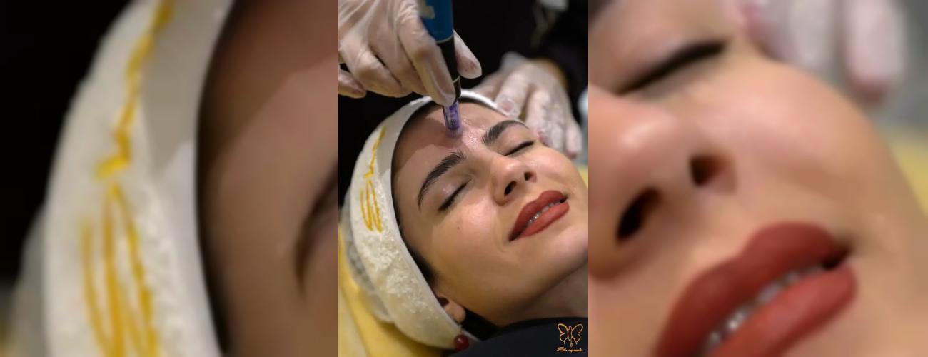 آیا پوسته‌ ریزی بعد از میکرونیدلینگ طبیعی است؟