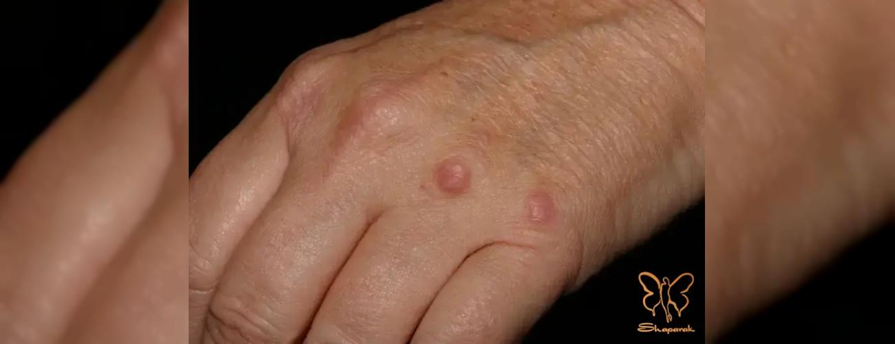 گرانولوما چیست؟ راه های درمان قطعی آن در مشهد