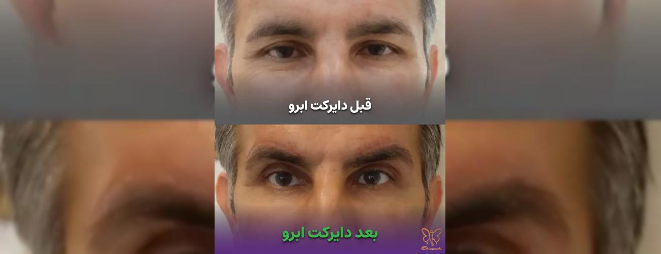درمان قطعی افتادگی و پف چشم: مقایسه کامل بلفاروپلاستی و دایرکت ابرو در کلینک شاپرک طلایی مشهد