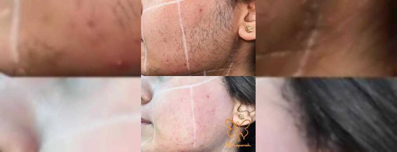 موهای زخیم یا نازک؟ تاثیر نوع مو بر موفقیت لیزر موهای زائد در مشهد