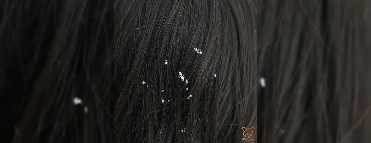 آیا واقعا شوره سر ناشی از خشکی پوست سر است؟