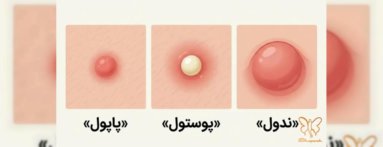 شناخت جوش‌های دردناک و ملتهب |  چرا نباید آنها را دستکاری کنیم؟ + درمان قطعی در مشهد