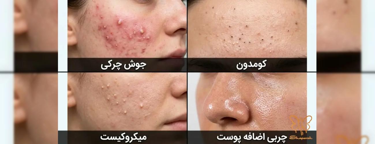 تفاوت جوش چرکی، کومدون، میکروکیست و چربی اضافه پوست | درمان انواع جوش در مشهد