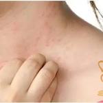 درماتوگرافیسم چیست؟ علت خط‌نویسی روی پوست + درمان دارویی و رفع لک با لیزر