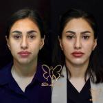 فیس‌لیفت مایع در دوران شیردهی؛ بررسی کامل ایمنی، عوارض و بهترین زمان انجام