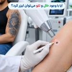 آیا لیزر روی تتو و خال ممنوع است؟ | رازهای طلایی در بهترین کلینیک لیزر مشهد!