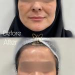 جوانسازی صورت بدون درد و بیهوشی با فیس لیفت مایع | کلینیک تخصصی شاپرک طلایی مشهد