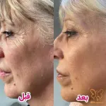 جوانی پوست با درمان فوتوایجینگ در کلینیک شاپرک مشهد
