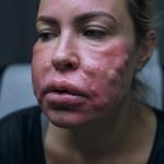 تفاوت فیلر اصل و تقلبی: انتخاب کلینیک معتبر تزریق ژل در مشهد