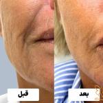 مزوژل جالپرو چیست ؟ تغذیه سلولی برای تولد دوباره پوست در مشهد
