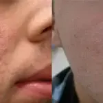 جوانی پوست با درمان فوتوایجینگ در کلینیک شاپرک مشهد