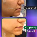 جوانسازی پوست با لیزر فوتونا فوردی: نه یک درمان، بلکه یک تولد دوباره!