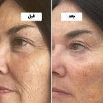 مزوژل جالپرو چیست ؟ تغذیه سلولی برای تولد دوباره پوست در مشهد