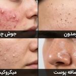 تفاوت جوش چرکی، کومدون، میکروکیست و چربی اضافه پوست | درمان انواع جوش در مشهد