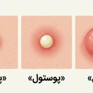 شناخت جوش‌های دردناک و ملتهب |  چرا نباید آنها را دستکاری کنیم؟ + درمان قطعی در مشهد