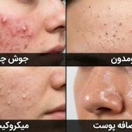 تفاوت جوش چرکی، کومدون، میکروکیست و چربی اضافه پوست | درمان انواع جوش در مشهد