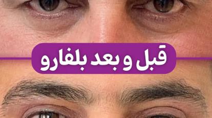 ۷ مزیت شگفت‌انگیز جراحی همزمان پلک بالا و پایین در مشهد که باید بدانید