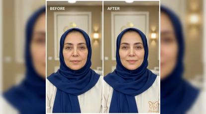 راز جوانسازی صورت: چرا چربی‌ها از بین می‌روند و چگونه فیلرها جوانی را به شما بازمیگردانند؟