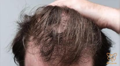 ریزش موی استرسی: تلوژن افلوویوم و درمان آن در کلینیک شاپرک مشهد