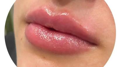 شیدینگ لب یا فیلر؟ کدام برای شما بهتر است؟ پاسخ تخصصی در شاپرک طلایی
