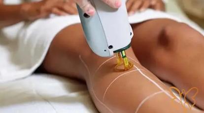 تاریخچه دستگاه لیزر موهای زائد: لیزر با موهای بدن شما دقیقا چه میکند؟