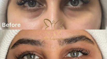 رفع گودی زیر چشم در کلینیک تخصصی شاپرک طلایی 