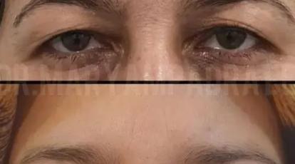 ترس از حمام بعد از عمل پلک را کنار بگذارید | آموزش گام به گام شستشوی ایمن