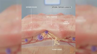 رهایی از کهیر مزمن: جدیدترین روش‌های درمانی در کلینیک شاپرک طلایی