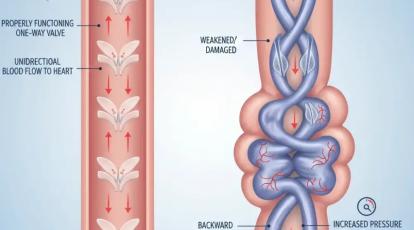لیزر واریس پا: جدیدترین روش درمان در کلینیک شاپرک طلایی مشهد (بدون جراحی)