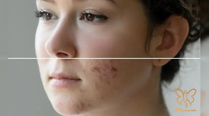 بررسی کامل بایدها و نبایدهای مصرف راکوتان و ایزوترتینوئین در کلینیک شاپرک مشهد