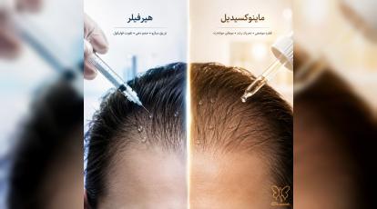 هیرفیلر یا ماینوکسیدیل؟ راهنمای قطعی درمان ریزش مو در مشهد + مقایسه کامل