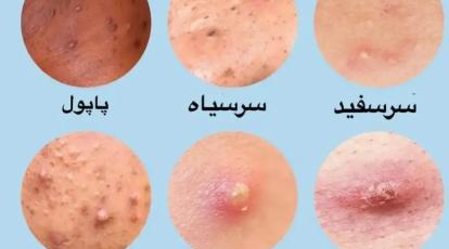 علت اصلی جوش‌های مزاحم باسن چیست؟ بهترین درمان‌های خانگی و کلینیکی در مشهد