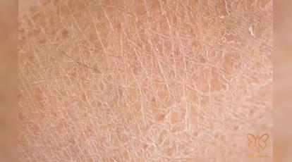 هایپرکراتوز: درمان قطعی ضخامت و زبری پوست در کلینیک شاپرک مشهد