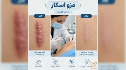 مزو اسکار چیست؟ بهترین روش تزریق کورتون برای جای زخم در کلینیک شاپرک طلایی مشهد