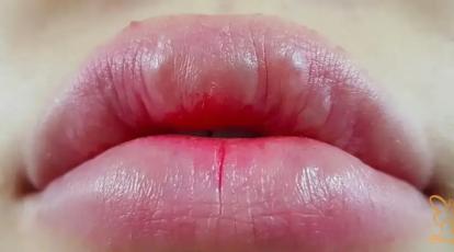 آیا گوله شدن فیلر زیر پوست خطرناک است؟ پاسخ قطعی پزشکان شاپرک طلایی مشهد